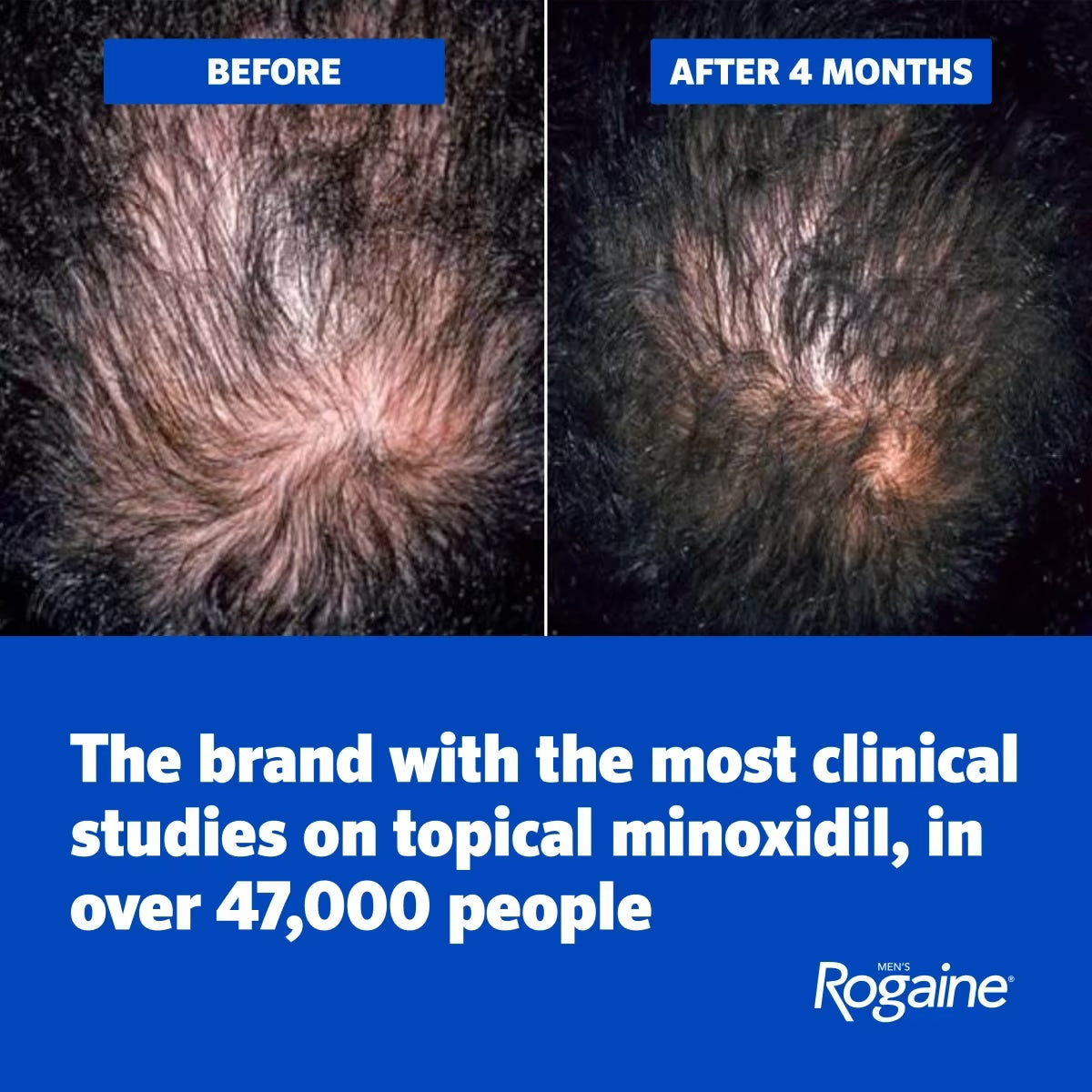 Men's ROGAINE® Extra Strength 5% Minoxidil Topical Solution Three Month Supply